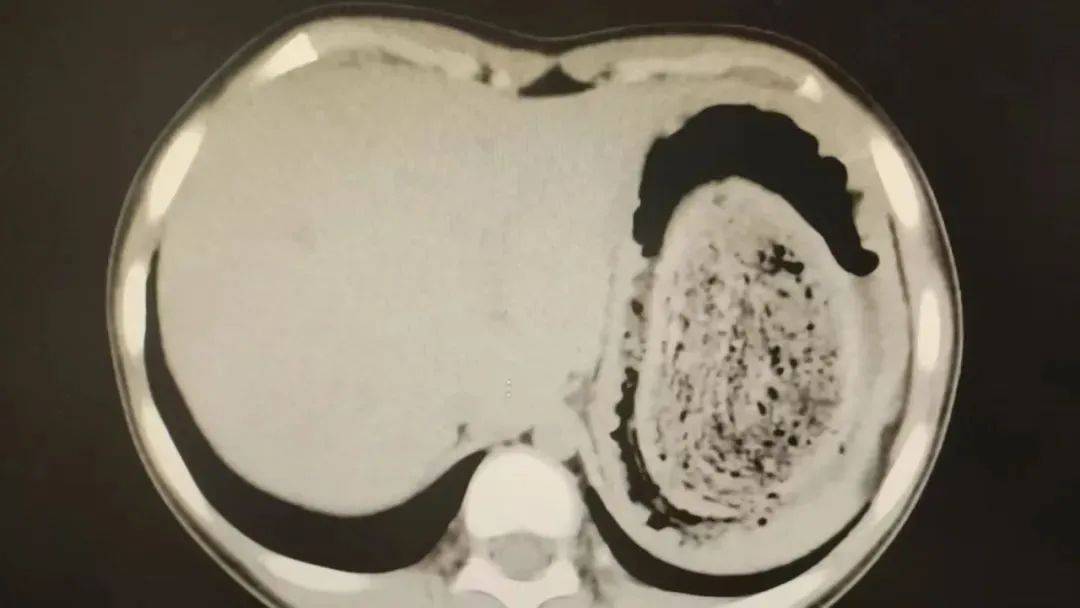 皇冠平台_发现一例皇冠平台,10岁女孩确诊!已有多起病例,有人因羞耻感延误就医