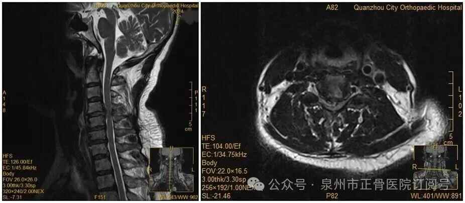罗瑟汉姆 vs 保顿艾尔宾_女子因手麻到医院就诊罗瑟汉姆 vs 保顿艾尔宾，拒绝医生颈椎手术建议，当晚翻身竟导致瘫痪，医生提醒→